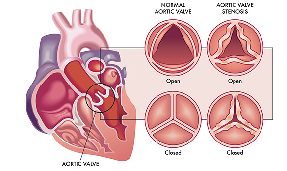 What is Calcific Aortic Valve Disease?